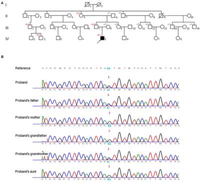 Case Report: A Novel Missense Mutation c.517G>C in the UMPS Gene Associated With Mild Orotic Aciduria